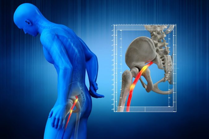 Sciatica pain