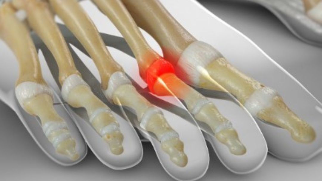 What Are The Symptoms Of Metatarsophalangeal Joint Dislocation