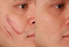 Why Choose Celibre for Laser Scar Removal in Torrance