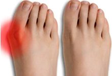 Where to Find Expert Minimally Invasive Bunion Surgery