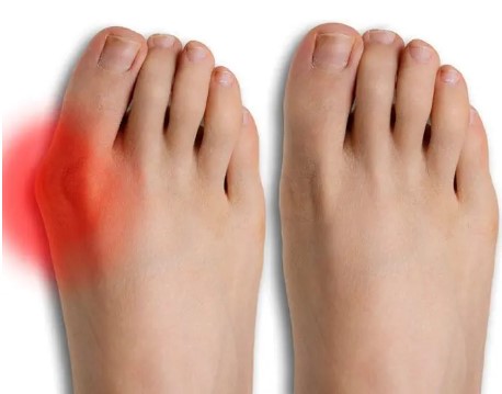 Where to Find Expert Minimally Invasive Bunion Surgery