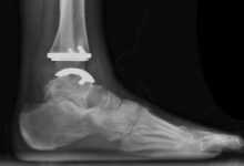 Where to Find Expert Total Ankle Replacement Care