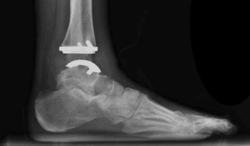 Where to Find Expert Total Ankle Replacement Care
