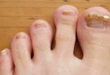 Where to Seek Help for Toenail Injuries Scottsdale's Top Center