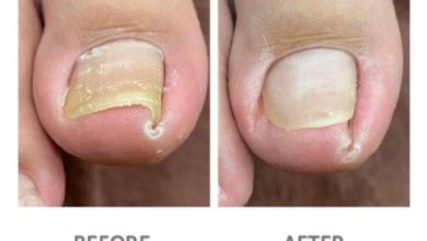 Where to Get Toenail Removal in Scottsdale