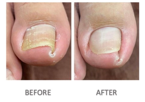Where to Get Toenail Removal in Scottsdale