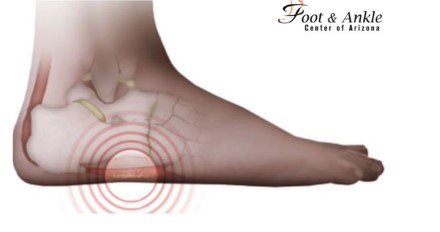 Which Conditions Cause Pain on Side of Foot