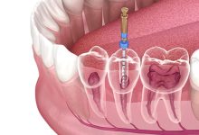 Can I Brush My Teeth After Root Canal