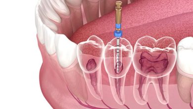 Can I Brush My Teeth After Root Canal