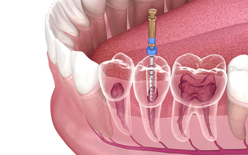 Can I Brush My Teeth After Root Canal