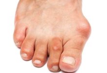 How Bunion Surgery Can Alleviate Foot Pain An In-Depth Look