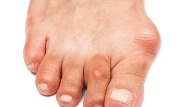 How Bunion Surgery Can Alleviate Foot Pain An In-Depth Look