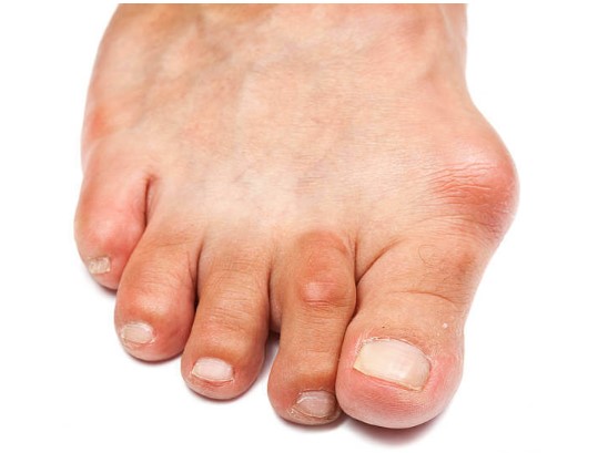 How Bunion Surgery Can Alleviate Foot Pain An In-Depth Look