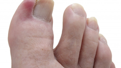 Why Is Matrixectomy Used for Treating Ingrown Toenails