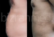 Vaser Liposuction