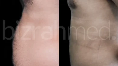 Vaser Liposuction