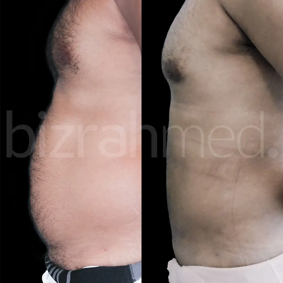 Vaser Liposuction