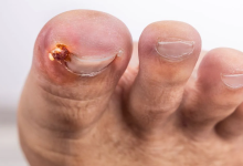 Who Can Explain Toenail Removal Healing Stages Clearly