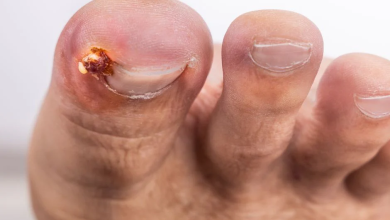 Who Can Explain Toenail Removal Healing Stages Clearly