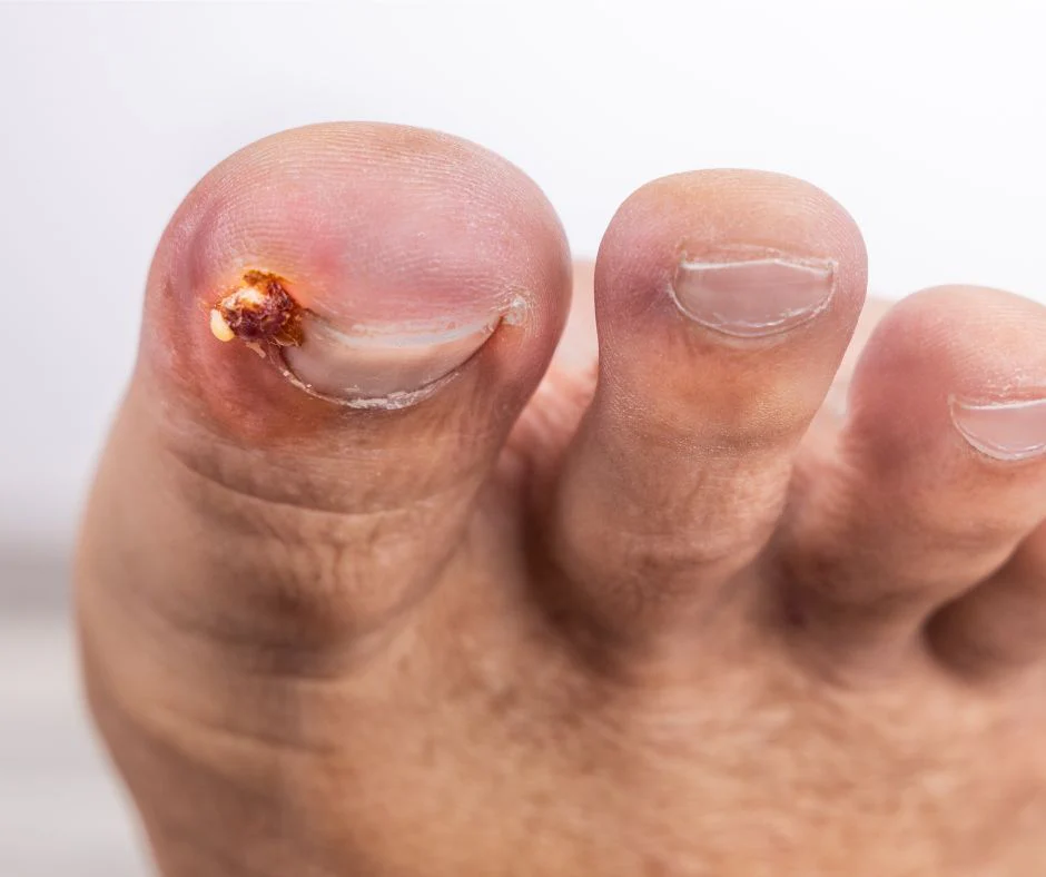 Who Can Explain Toenail Removal Healing Stages Clearly